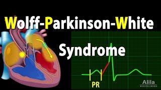 WolffParkinsonWhite Syndrome Pathophysiology PreExcitation and AVRT Animation [upl. by Dilan]