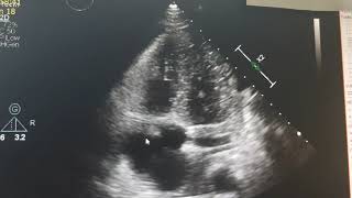 Infectious endocarditis Echocardiography [upl. by Picardi958]