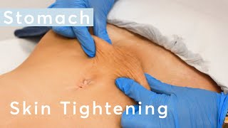 Skin Tightening Stomach  HIFU Ultraformer III Treatment [upl. by Larok]