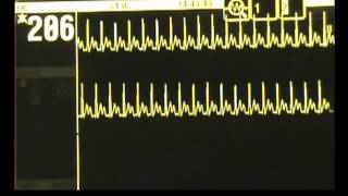 New Vagal Maneuver for Supraventricular Tachycardias [upl. by Ceil]