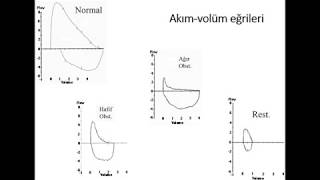 Solunum Fonksiyon Testi sonuçlarının yorumlanması dersi [upl. by Ynner608]