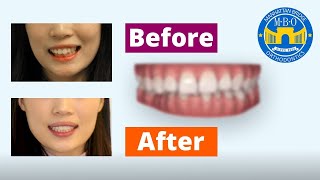 Invisalign Before and After Correcting Bite [upl. by Ternan]