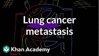 LUNG CANCER Part 1 Epidemiology Etiopathogenesis Precursor lesions amp Classification [upl. by Ayrad]