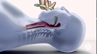 ACLS Using an LMA [upl. by Anaz]