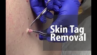 Skin Tag Removal  Dr Derm [upl. by Aniela841]