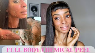 CHEMICAL PEEL  Full Peeling Process BEFORE amp AFTER  How To Get Rid of Hyperpigmentation [upl. by Aniles416]