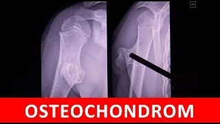 Osteochondrom  MRT CT und Röntgen Darstellung  by Radiologie TV [upl. by Esinaej]