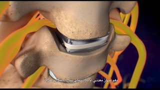 Cervical Disc Removal [upl. by Aeirdna410]