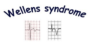 Wellens syndrome [upl. by Abelard]