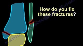 Ankle Fractures Surgical Treatment tactics  Everything You Need To Know  Dr Nabil Ebraheim [upl. by Helmer]