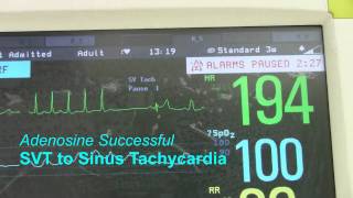 SVT or Supraventricular Tachycardia [upl. by Nevil]