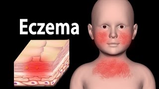 Eczema Animation [upl. by Arahsit]