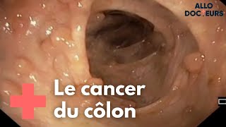 Cancer colorectal  quelle prise en charge   Allo Docteurs [upl. by Pich]