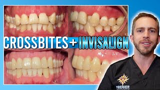 Invisalign Crossbite Treatment BEFORE amp AFTER [upl. by Eiramnwad319]