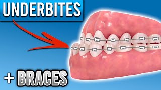 How Do Braces Fix Underbites  Premier Orthodontics [upl. by Eux]