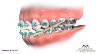 Orthodontics Treatment for Underbite or Crossbite  Rubber Bands [upl. by Daberath]