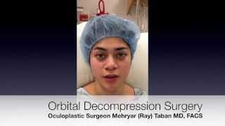 Orbital Decompression Surgery Los Angeles Beverly Hills [upl. by Enahs]