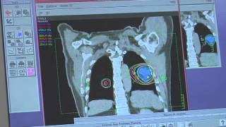 Cancer Treated with Radiation Therapy [upl. by Adnim]