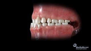 Anterior Crossbite Skeletal or Functional [upl. by Lee]