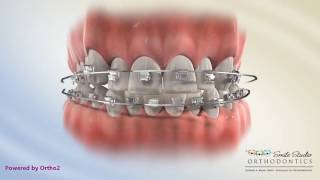 Damon Posterior Crossbite   Orthodontic Treatment [upl. by Sukramaj]