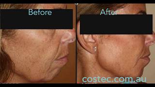 HIFU™ treatment  Before amp After pictures for Face Lift and Skin Tightening [upl. by Meilen]