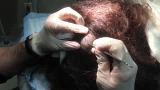 Pilar Cyst Removal on the Scalp [upl. by Arezzini]