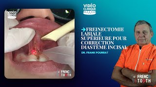 Functional frenuloplasty updated technique with lingual palatal suction [upl. by Alimat]