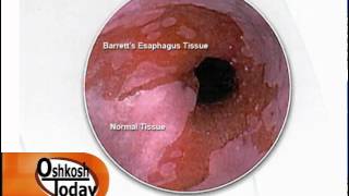 Barretts Esophagus [upl. by Sheffy475]