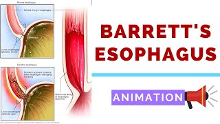 Barretts Esophagus  Pathology Dysplasia and Carcinoma [upl. by Anoy]