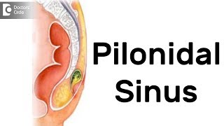 What is Pilonidal Sinus Symptoms Diagnosis Treatment  Dr Rajasekhar M R [upl. by Ecnerwaled]