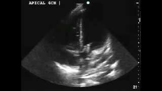 Aortic and Mitral Valve Endocarditis [upl. by Erme]