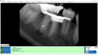 Training Apteryx XrayVision DCV Image Calibration and Measurement [upl. by Carline]