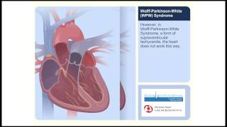 WPW WolffParkinsonWhite Syndrome Animation Video [upl. by Amles]