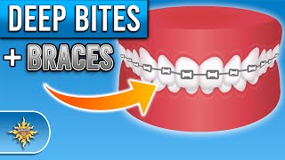 How Do Braces Fix Deep Bites  Premier Orthodontics [upl. by Adnohsek]