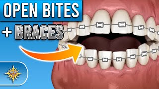 How Do Braces Fix Open Bites  Premier Orthodontics [upl. by Latif]