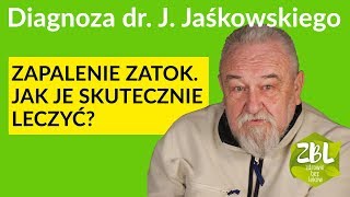 dr Jerzy Jaśkowski  Leczenie zapalenia zatok [upl. by Eatnhoj774]