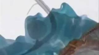 Laryngeal Mask Airway Insertion [upl. by Cadmar]