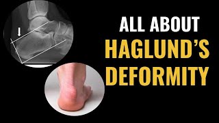 How Do I Treat A Haglunds Deformity [upl. by Oiliruam]