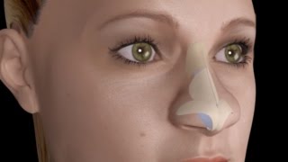 Bulbous Large Nasal Tip Nose Job Rhinoplasty [upl. by Lossa]