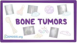 Bone tumors  causes symptoms diagnosis treatment pathology [upl. by Shalna]