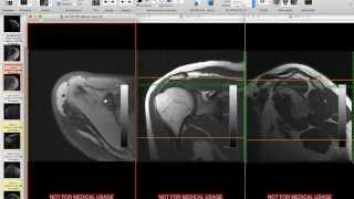 Systematic Interpretation of Shoulder MRI How I do it [upl. by Swisher]