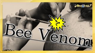 Bee venom medical treatment [upl. by Eadwina]