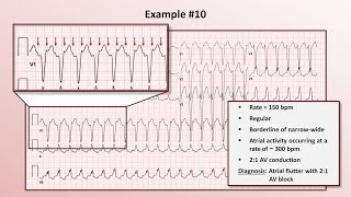 Intro to EKG Interpretation  Practicing Tachyarrhythmia Identification [upl. by Cody]