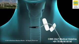 Thyroidectomy – CIMS Hospital [upl. by Siraval897]