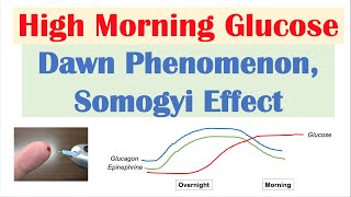 High Early Morning Glucose  Dawn Phenomenon amp Somogyi Effect [upl. by Eylatan]