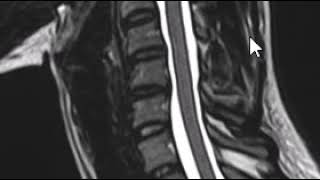 How to read and MRI of the cervical spine  First Look MRI [upl. by Animas539]