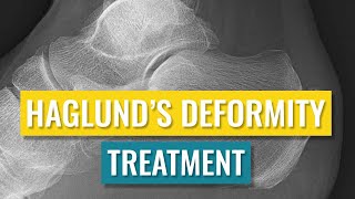 Haglunds Deformity Treatment [upl. by Annawahs]