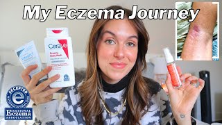 HOW I BEAT MY ECZEMA FOR GOOD  My journey product recommendations  body care tips  Rudi Berry [upl. by Ytsirhc]