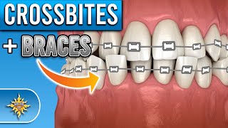 How Do BRACES Fix Crossbites [upl. by Nelaf432]