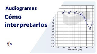 AUDIOGRAMA  Entiende el resultado de una audiometría tonal [upl. by Niliak]